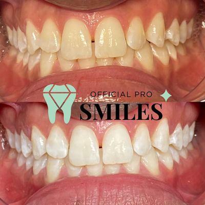 Teeth whitening chandler Arizona. www.Officialprosmiles.com