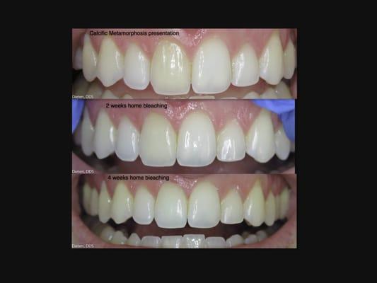 Prior trauma caused this tooth to darken. One month of home bleaching brought its natural color back.