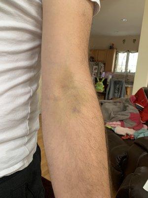 Unacceptable amount of bruising from blood draw and trying (and failing) to insert IV