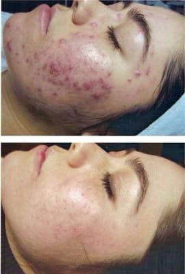 Cystic acne treatment over 5 months