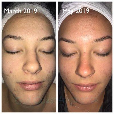 Mid-treatment results from a series of acne facials performed on a young lady in her early 20's.