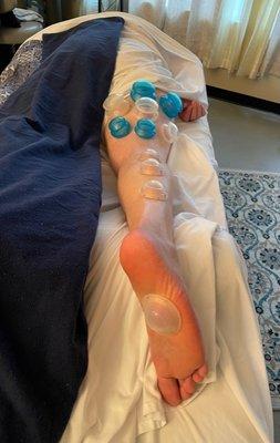 Cupping Therapy