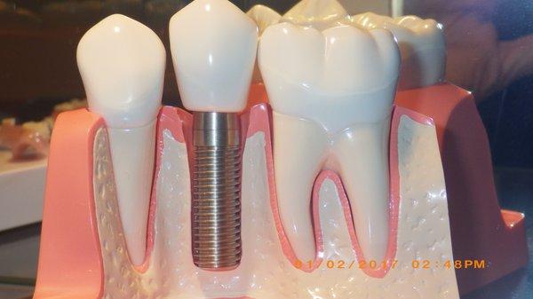 Dental Implant