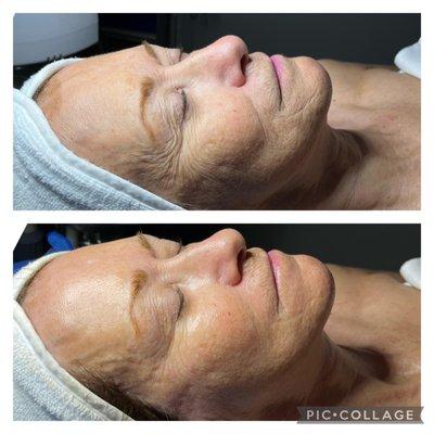 Beyond Botox Firming Facial