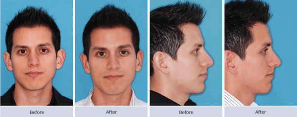 Otoplasty Surgery Before & After