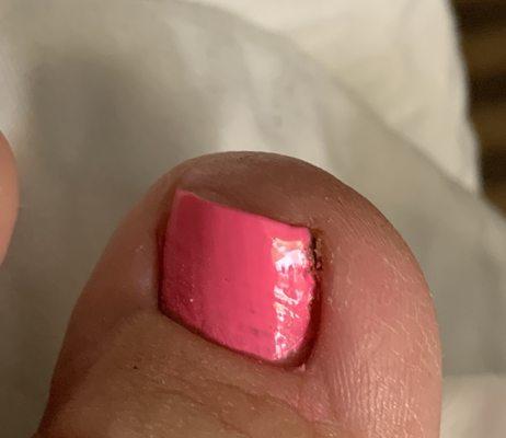 Bloody toenail and awful polish-photo taken same day of visit