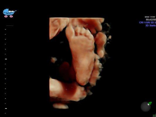 3D/4D of Baby's foot