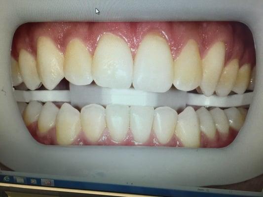 Whitening case: before treatment.