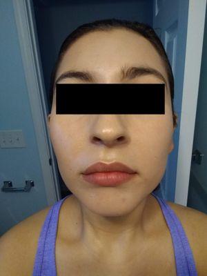 first week after procedure (w/tinted moisturizer)