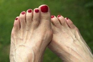 Bunion and Hammertoe surgery and treatment