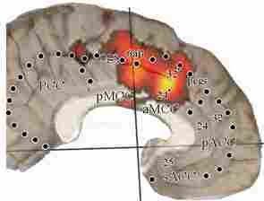 This is the brain imaged in a ladies her early 20s that had been raped at the ages of 4-7. She had severe abdominal pain and IBS