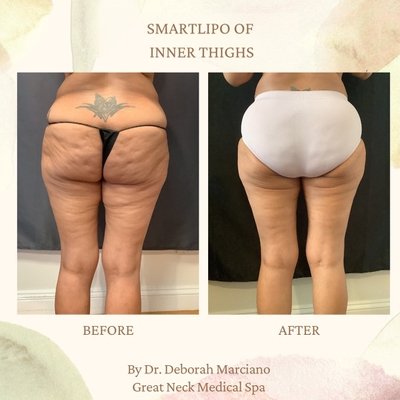 Smartlipo of inner thighs