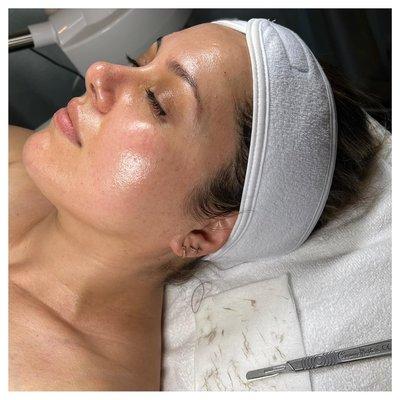 Dermaplaning Facial Glow