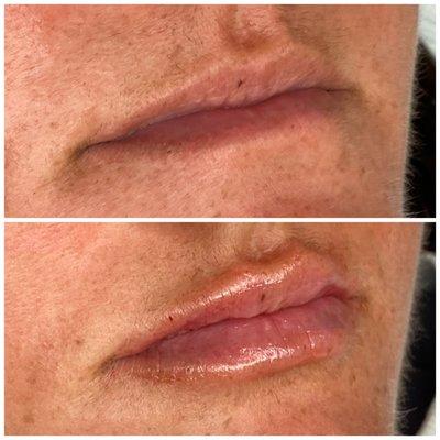 Lip augmentation