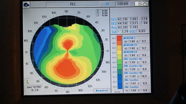 Corneal topography: an important tool to determine contact lens fits and in screening who is or is not a candidate for refractive surgery.