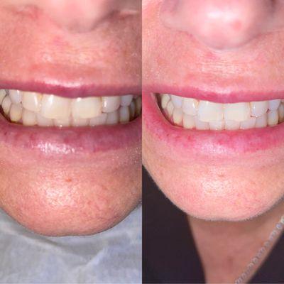 20 minute teeth whitening $99 cash