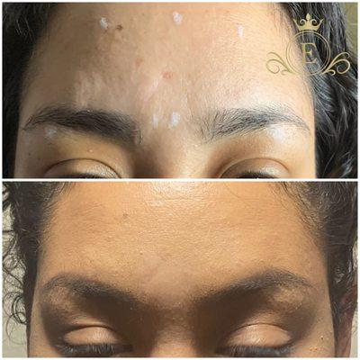 Botox to smooth forehead lines and give a beautiful eyebrow lift