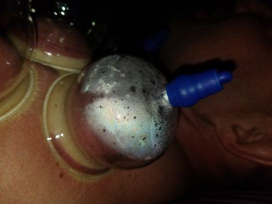 Cupping Therapy help with inflammation. #cuppingtherapy