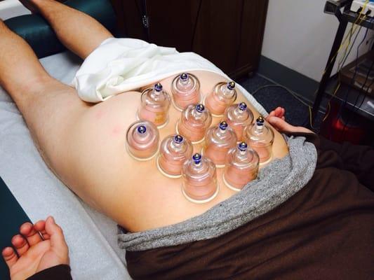 Dr Woo cupping