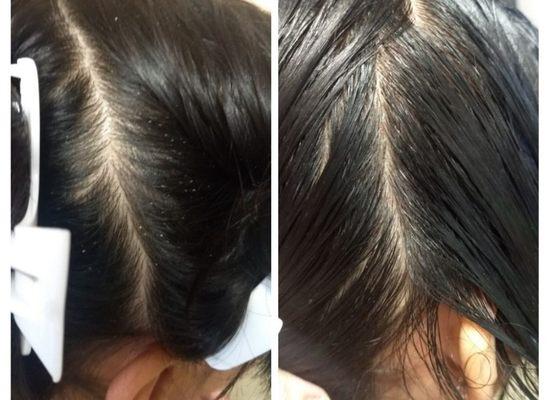 Lice and Nit removal and treatment