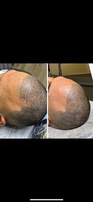 Great hairline restoration, just another awesome example on how Scalp Micropigmentation works