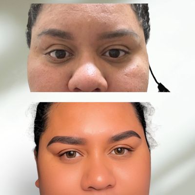 Brow Correction