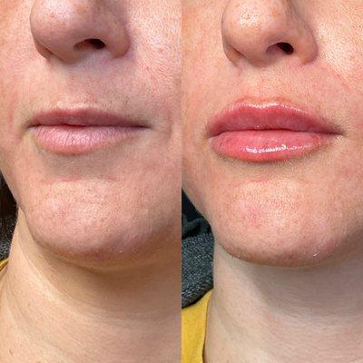 Before and after lip filler