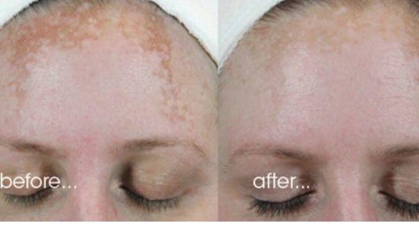 Hyper-Pigmentation treatments.