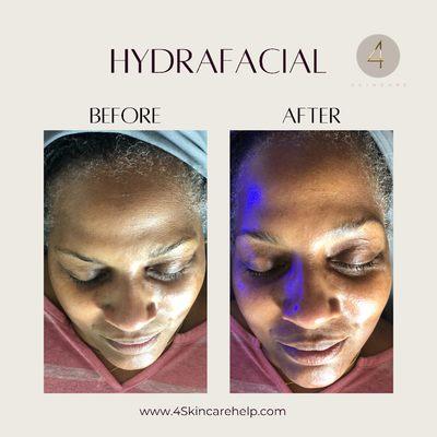 Before and after of 1 Hydrafacial treatment