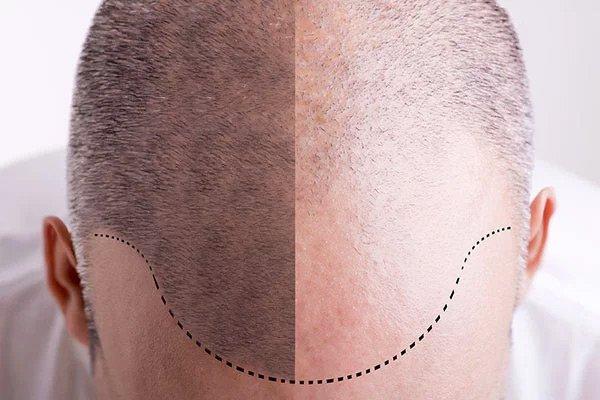 Hair restoration procedure overview