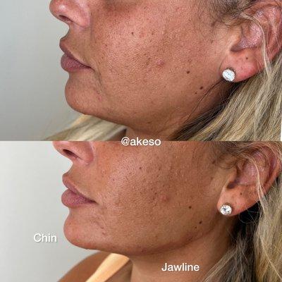 JAWLINE & CHIN WITH FILLER