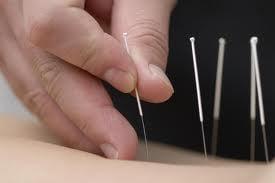 Dr Hsu provides acupuncture treatments