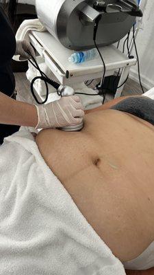 Cavitation on the midsection to reduce fat calls