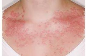 allergic rash can show up anywhere!