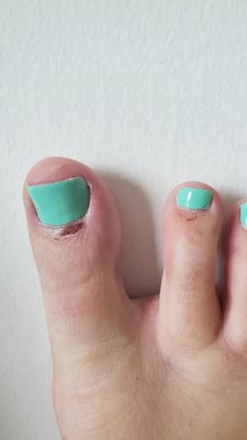 3 days after pedicure. Finally stopped bleeding.