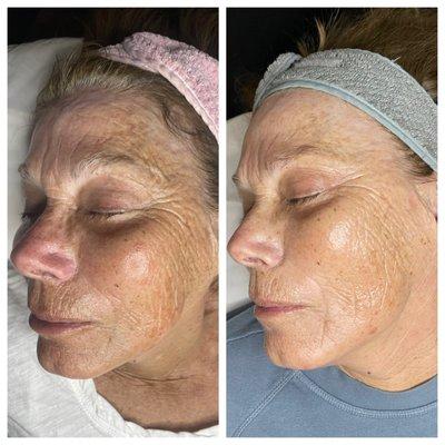 Anti aging facial