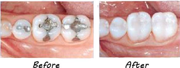 Before and after photo of Dr. Albert Broas' quality dental work.