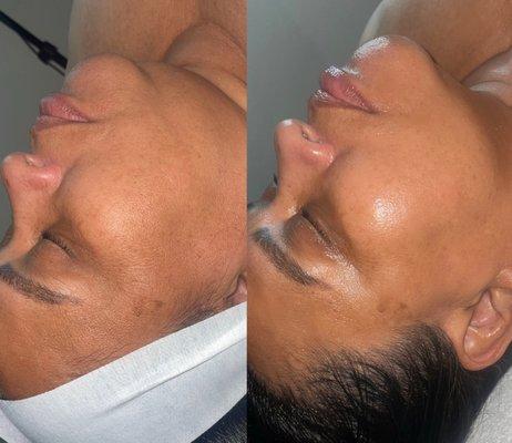 Radio Frequency Facial