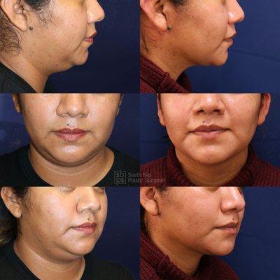 This patient underwent buccal fat removal and chin liposuction.