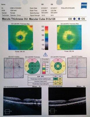 Ocular Coherence Tomography: An amazing tool allowing us to non-invasively evaluate the nerve fiber layer of the macula and retina.