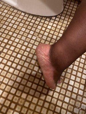 How my foot was left.