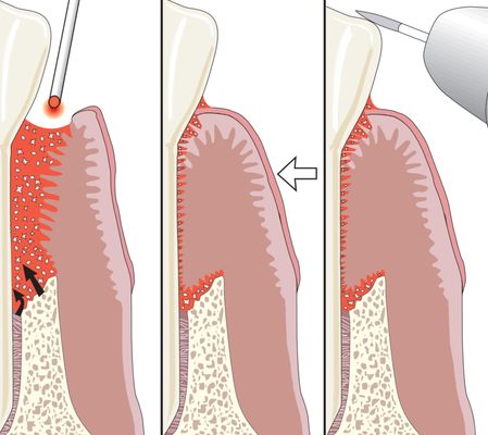 Minimally Invasive Laser Periodontal Therapy...LANAP