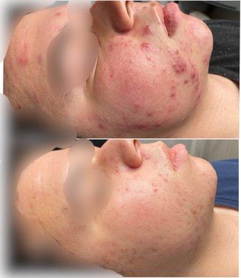 Anti-Acne Facial Results