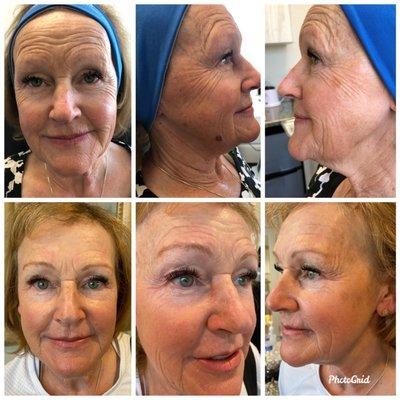 Before and After PDO Threads Non Surgical Face Lift