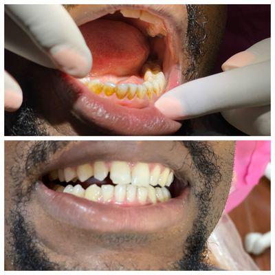 Results of a regular dental cleaning.