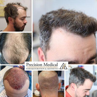 Amazing 6 month transformation from FUE by Dr Plaman at Precision Medical!