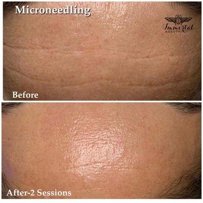 Microneedling-Collagen Induction Therapy