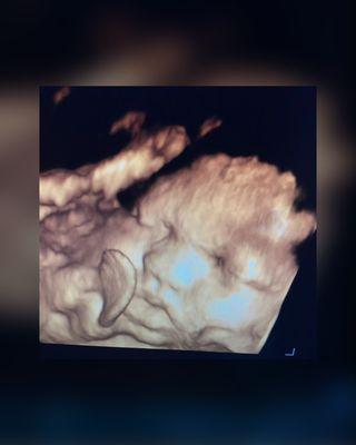 3D/4D Ultrasounds