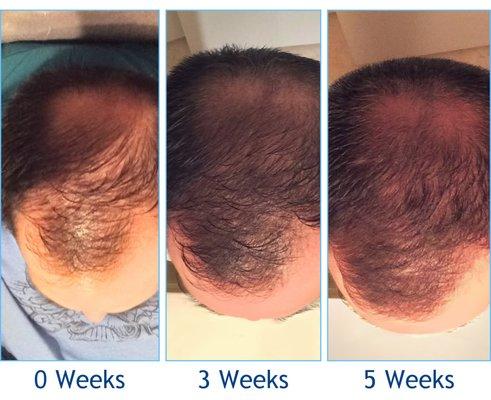 Dr. Blay offers PRP Hair Restoration therapy for fantastic results!