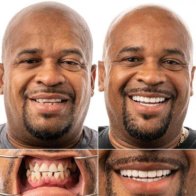 Beautiful before/after with Full Mouth Implants